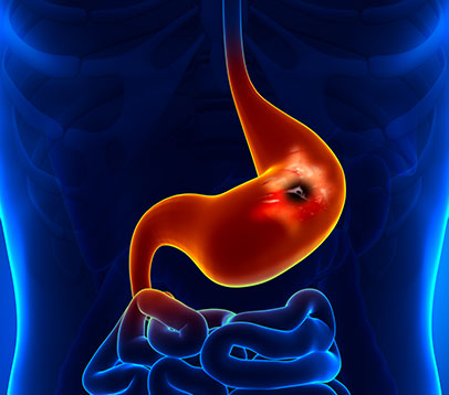 Ulkusna bolest - Gastroenterolog - Kolegium Medic