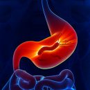 Helicobacter Pilori - Gastroenterolog - Kolegium Medic