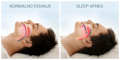 Sleep apnea - Poremećaji disanja - Kolegium Medic